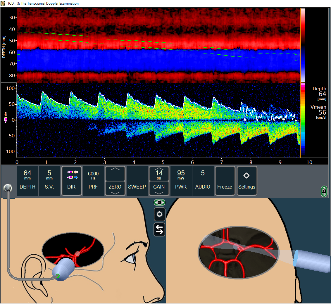 TCD Simulation of B-mode